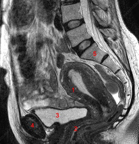 Mri Female Pelvis Anatomy