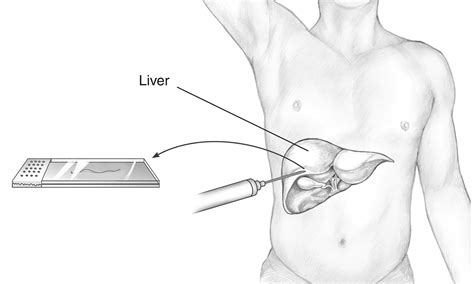 Liver biopsy procedure | Media Asset | NIDDK