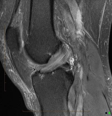 mucoid degeneration of acl treatment - geraldroegner-99