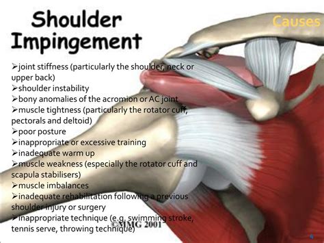 MRI Shoulder Impingement Syndrome