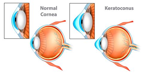 Keratoconus & Specialty Lenses - Roswell Eye Clinic