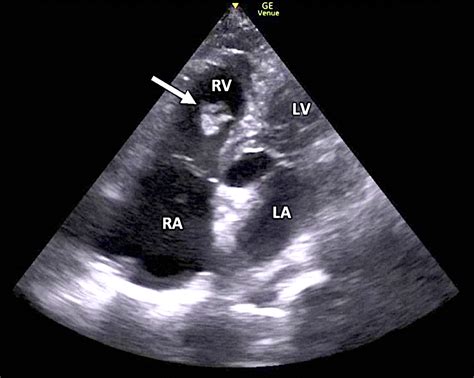 Cureus | Right Heart Thrombus in Transit Diagnosed With Focused Cardiac Ultrasound in the ...