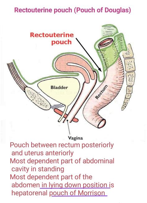 Pouch of Douglas... | anatomy | Pinterest