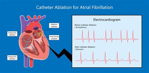 Ventricular Flutter Vs Fibrillation