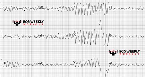 Potpourri of cases: generic polymorphic ventricular tachycardia vs. torsades de pointes ...