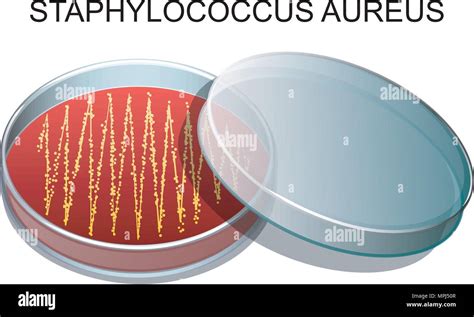 illustration of a culture of Staphylococcus aureus in a Petri dish ...