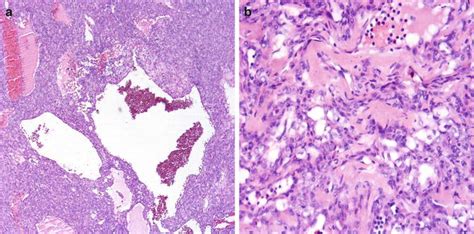 Benign Tumors of the Lung in Small Lung Biopsies | Thoracic Key