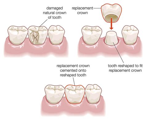 Cracked tooth syndrome : Indications, Treatments and Precautions ...