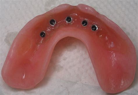 Mini Dental Implants - A Dental Assistants View