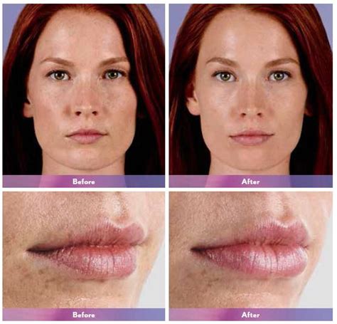 Juvederm Before & After Photos, Juvederm Costs & Side Effects