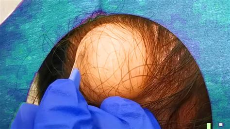 Giant Scalp Cyst Popping! DB's Pilar Cyst Removal!