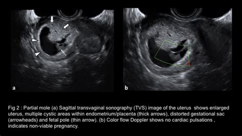 Partial Mole A Sagittal Transvaginal Sonography Tvs | My XXX Hot Girl
