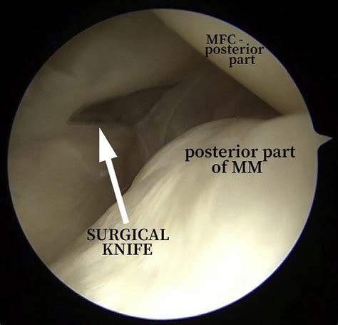 Arthroscopic view of posteromedial recess of right knee via trans-notch... | Download Scientific ...