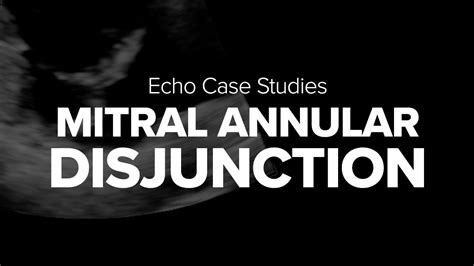 Echo Case #2 | Mitral Annular Disjunction - YouTube