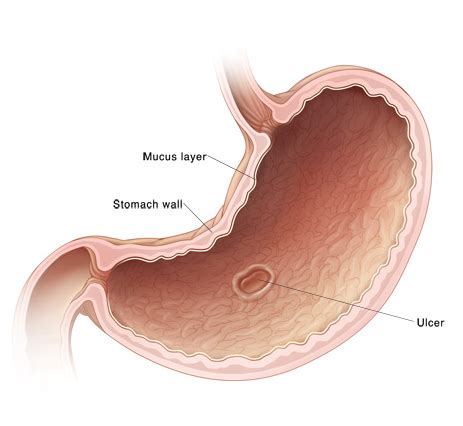 Stomach and Duodenal Ulcers - Children's Hospital of Orange County