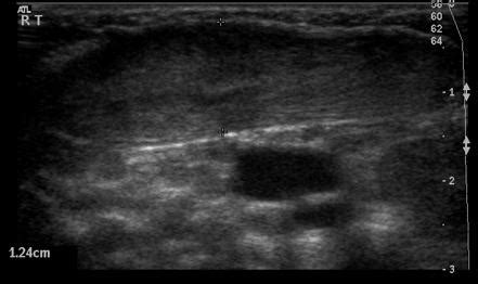 Fibromatosis colli | Image | Radiopaedia.org