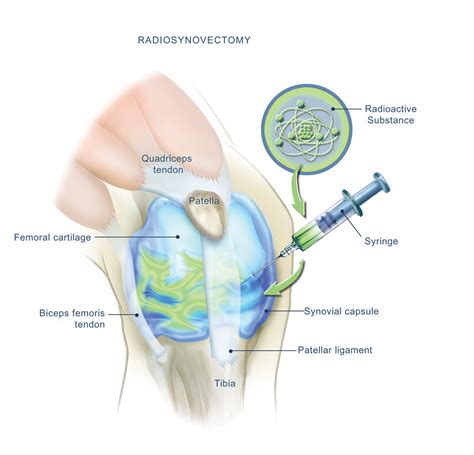 Amrita Hospitals introduces first-ever Radio-Synovectomy procedure for ...