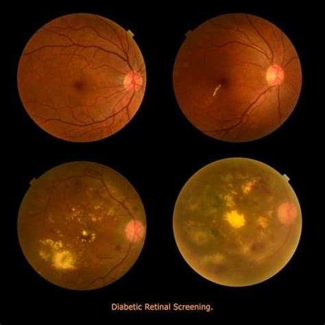 Diabetic Retinopathy Screening and Retinal Micro-Aneurysm Detection