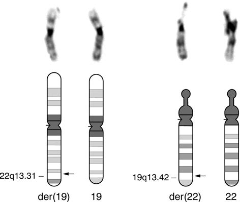 Cryptic subtelomeric translocations in the 22q13 deletion syndrome ...