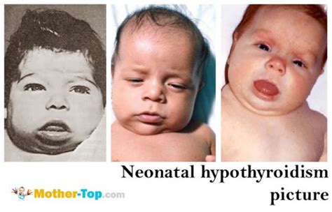 Congenital Hypothyroidism