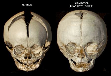 Sinostosis coronal bilateral