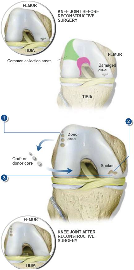 OATS Cartilage Repair Surgery | Central Coast Orthopedic Medical Group