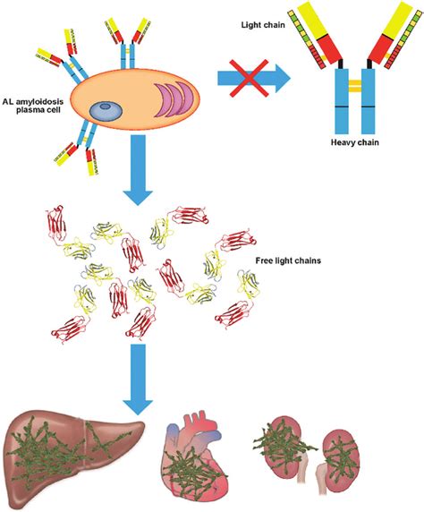 Light chain amyloidosis pathology. Clonal expansion of plasma cells... | Download Scientific Diagram