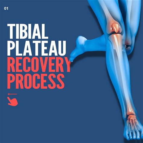 Tibial Plateau Fracture Settlement **($35M+ Recovered)**