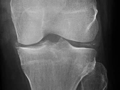 Daily Dose: Chondrocalcinosis knee