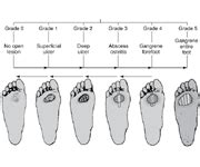 Wagner Ulcer Grade Classification Scale flashcards | Quizlet