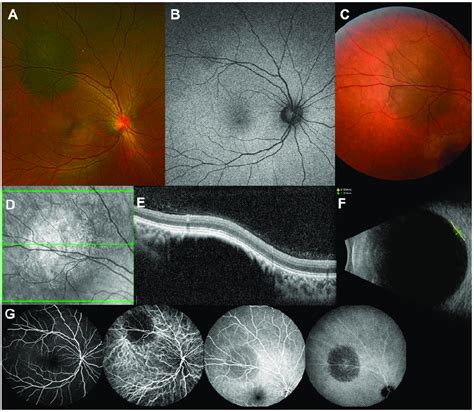 Multimodal imaging of a benign choroidal nevus of a Korean patient. A... | Download Scientific ...