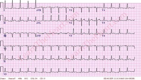 Wolff-Parkinson-White (WPW) ECG (Example 1) | Learn the Heart