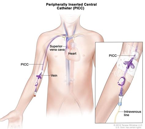 Picc Line Infusions Without Pumps