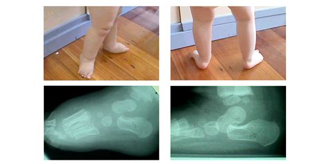 Children’s feet: Simple tests for problems – Foot Link Podiatrists