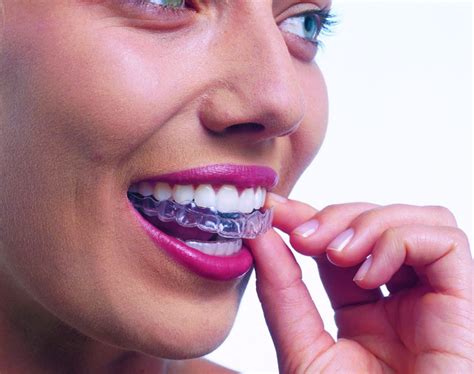 8 things you should know about Invisalign & clear aligners, according ...