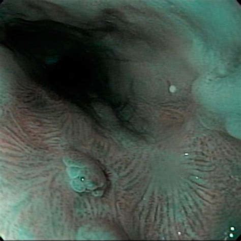 Esophagogastroduodenoscopy of the lower esophagus revealing squamous... | Download Scientific ...