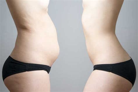 Vaser Lipo Recovery - Hints and Tips ensure fabulous results