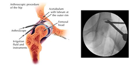 Low-Cost Best Hip Arthroscopy Surgery In India [2020]