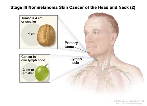 Lymph Nodes Neck Cancer