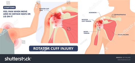 211 Rotator Cuff Tear Images, Stock Photos & Vectors | Shutterstock