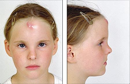 An Abscess on the Forehead | AAFP