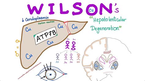 Wilson Disease: Causes, Symptoms, Diagnosis and Treatment | Healthtian