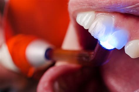 Understanding the Cost of Dental Bonding