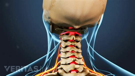 Herniated Cervical Disc