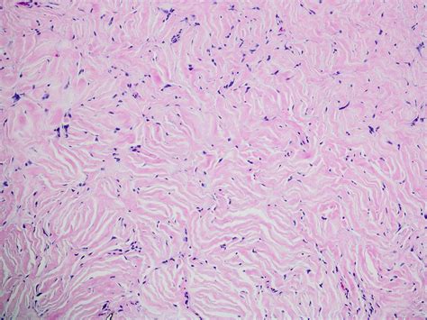 Focus on fibrotic lesions with multinucleated giant cells - New York Pathological Society