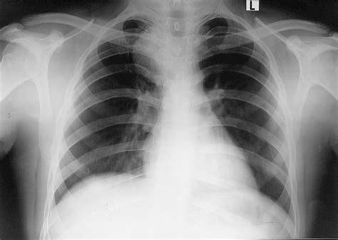 Bronchogenic Cyst | CTSNet