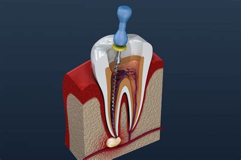 Devitalizzazione di un dente