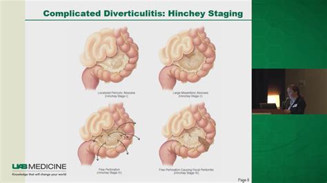 Diverticulitis: To Operate or Not? - YouTube