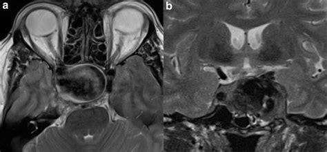 MRI T2 images of the ICA aneurysm in Patient 1 in axial view (a) and ...