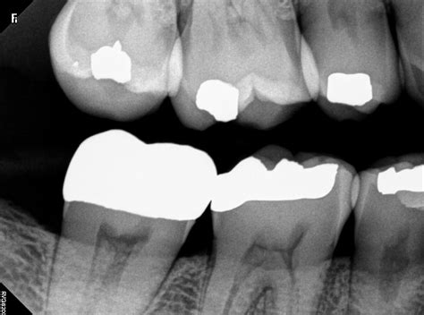 Taking Bitewing Dental X Rays